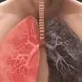 phytothérapie et cancer du poumon